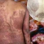 Европада хавфли инфекция тарқалмоқда