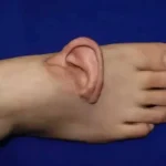 Қулоқни оёқда сақлашди: Хитойда ноодатий жарроҳлик тарихи ёзилди