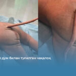 Вестигиал дум билан туғилган чақалоқ